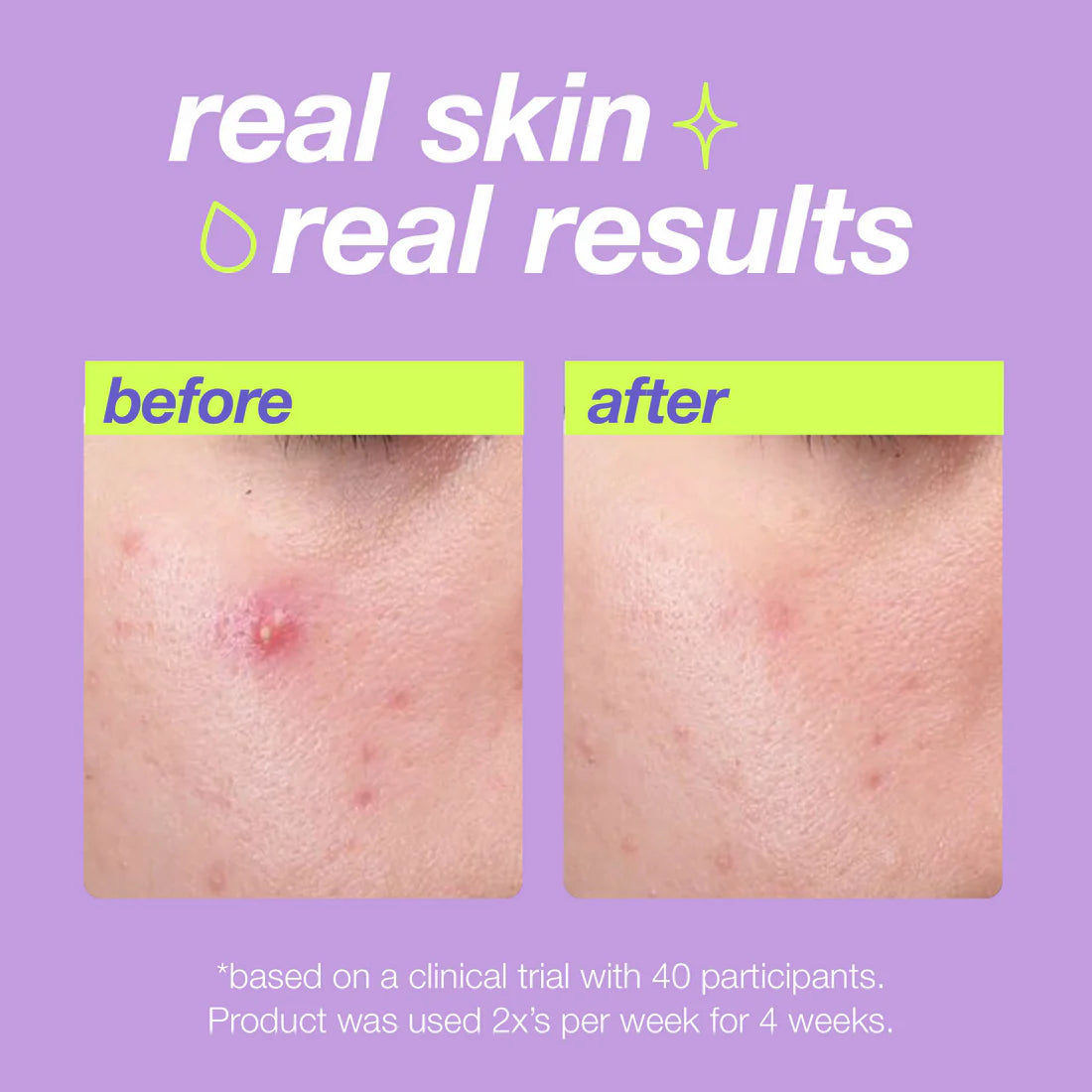 breakout clearing liquid peel